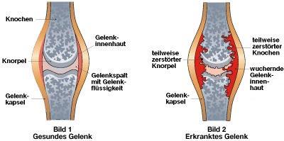 Rheumatoide Arthritis